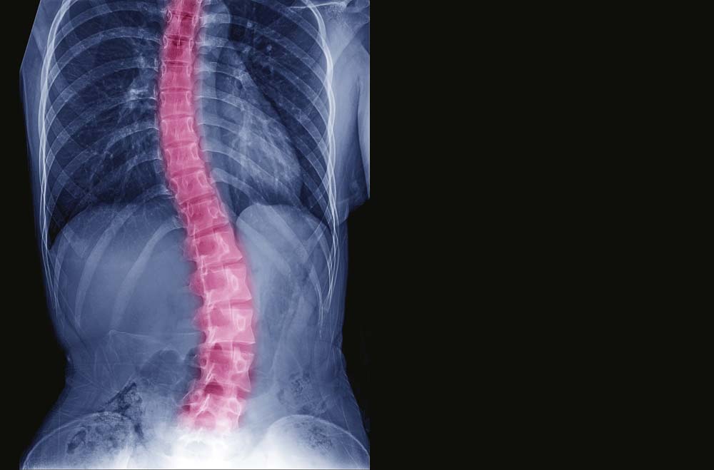 Scoliosis